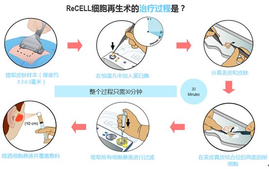 ReCell自体皮肤活性细胞移植术